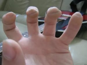 Болят пальцы и подушечки пальцев