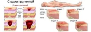 Вопрос по лечению пролежней