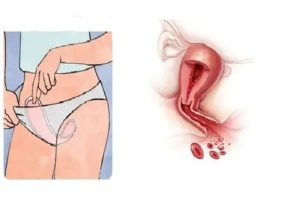 Возможен ли половой акт во время менструации?