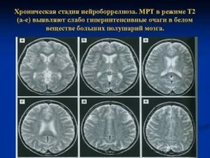 Гиперинтенсивные очаги в головном мозге