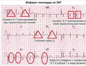 Может ли ЭКГ прояснить ситуацию?