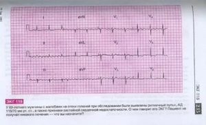 Может ли ЭКГ прояснить ситуацию?