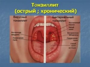 Хронический тонзиллит, зуд в горле