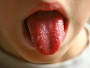 Сыпь под языком