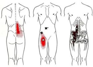 Боли в подвздошно-поясничной мышце