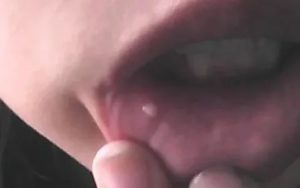 На уздечке под языком появилось белое пятно, возможен сифилис?