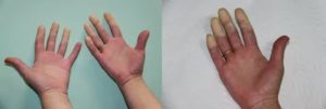 Немеют пальцы на руке после артроскопической операции