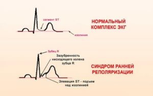 Может ли ЭКГ прояснить ситуацию?