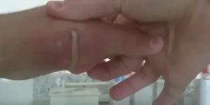 Опух палец после пореза