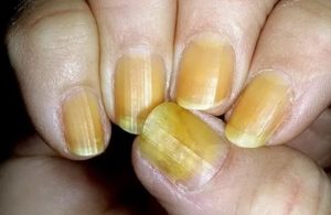Желтое пятно на ногте