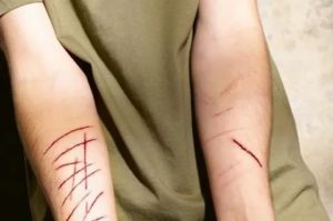 Последствия пореза на руке