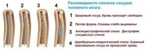 Спазм сосудов шеи при беременности