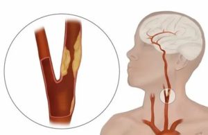 Уплотнение в области сонной артерии