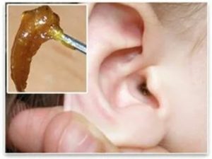 Может ли при серной пробке сильно болеть ухо?