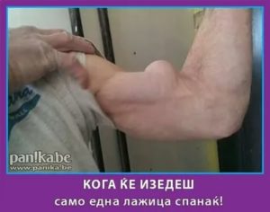 Шишка на бицепсе