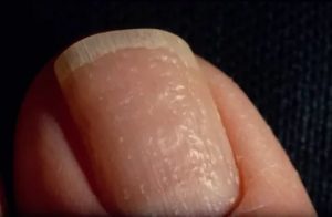 Дырочки на ногтях