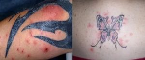 Риск заражения крови при татуировке