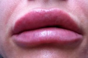 Периодически опухают губы, к какому врачу обращаться?