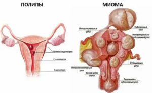 У меня миома больших размеров, я хожу в бассейн, это вредно?