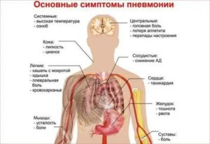 Холодный пот и боли при пневмонии