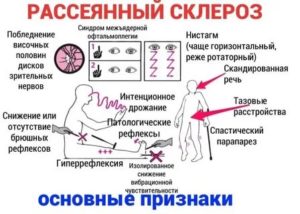 Заразен ли рассеянный склероз?