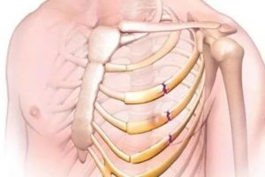 После бега болят грудные рёбра