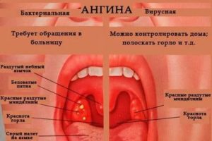 Боль в горле, температура 37,4 ~ 37,6