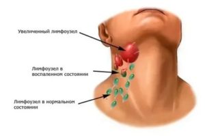 Увеличились лимфоузлы, стоматит