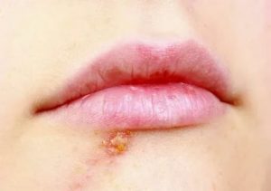 Сколько дней заразен герпес на губе?
