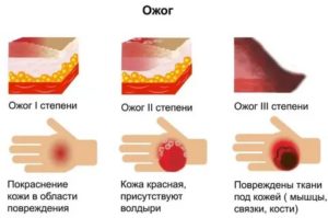 Куда обратиться с ожогом?