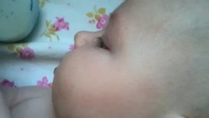 У ребенка на лице мелкая бесцветная сыпь