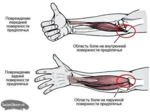 Болят руки в локтевых сгибах