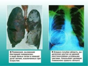 Могут ли быть у меня проблемы с лёгкими?