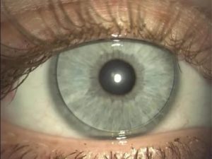 Можно ли носить контактную линзу на одном глазу для коррекции зрения?