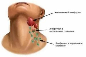 Увеличен подчелюстной лимфоузел, субфебрильная температура