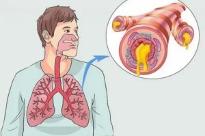 Сильный кашель с мокротой после операции на кишечнике
