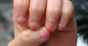 Ребёнок грызёт кожу на пальцах