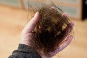 Поликистоз, выпадают волосы - клоками