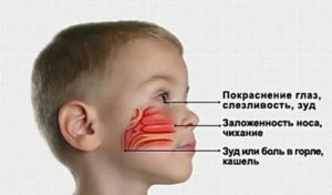 У ребенка заложен нос, температура