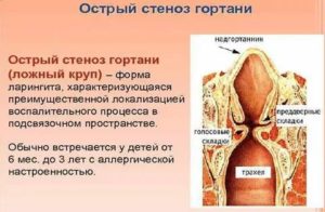 У ребенка часто случается стеноз гортани