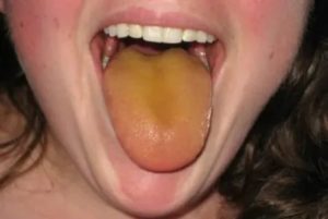 Желтый налет на языке и горле