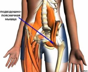 Боли в подвздошно-поясничной мышце