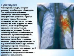 Отеки тела, туберкулез