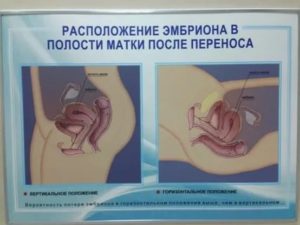 Запоры после переноса эмбриона
