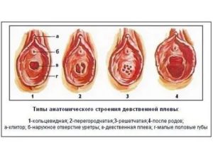 Вопросы о перегородчатой девственной плеве