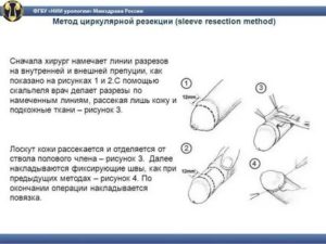 Когда должна открываться головка у мальчика?