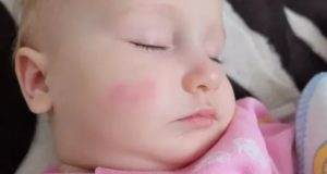 Красные шершавые пятна на щеках у ребенка