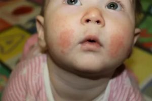 Красные шершавые пятна на щеках у ребенка