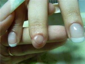 Не растут ногти после травмы кисти