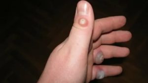 Отек палец после удаления бородавок